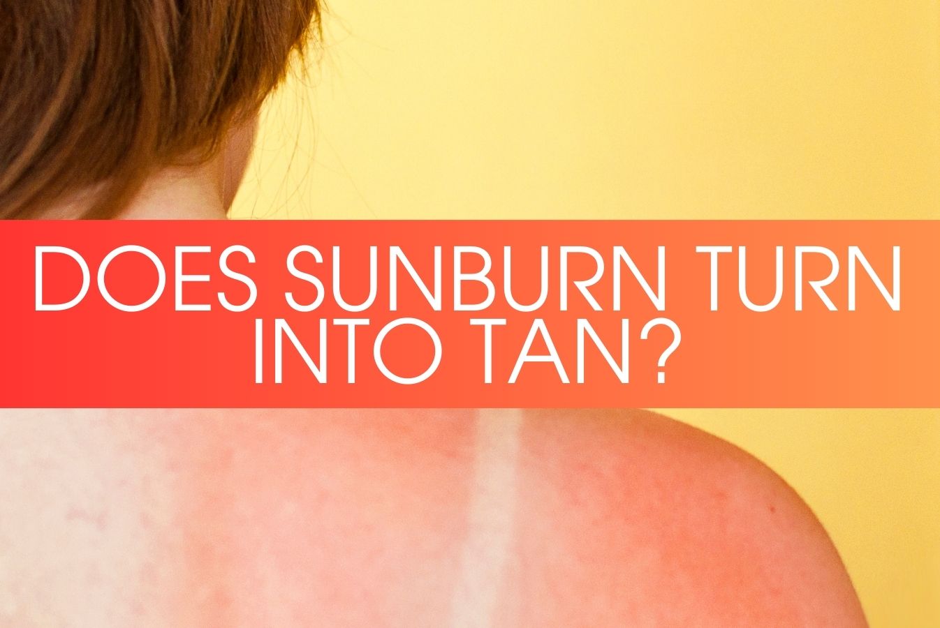 A header image showing the post title and sunburnt skin