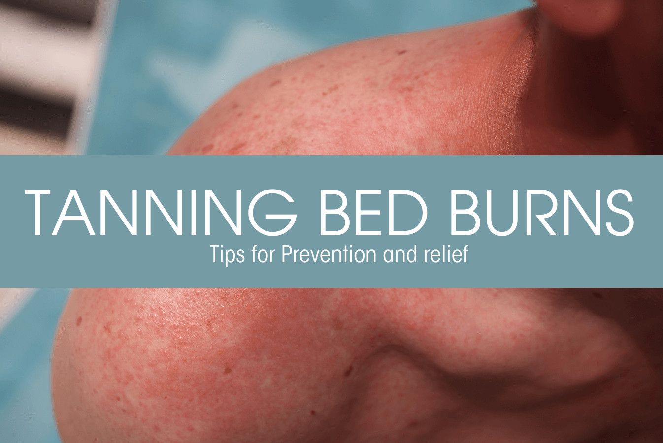 Featured image of a man with tanning bed burn
