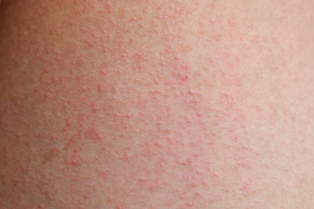 Tanning bed rash